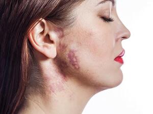 دلكي الوحمه بعصير الليمون المخفف بالماء 3 مرات يومياً