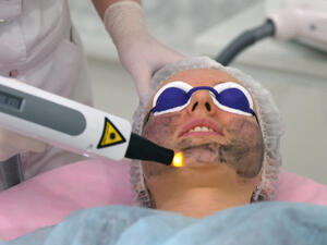 تُستخدم تقنية التقشير الكربوني في علاج جميع أنواع البشرة 
