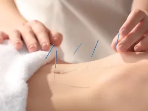 الإبر الصينية تعالج حالات الأرق والإرهاق
