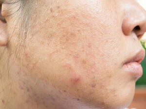 حفر الوجه هي آثار يخلفها حب الشّباب عندما يتم نتف رأس الحب باليد 
