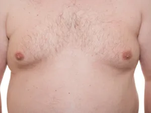 ظهور ثدي في جسد الرجل، يعد خبرًا سيئًا للغاية

