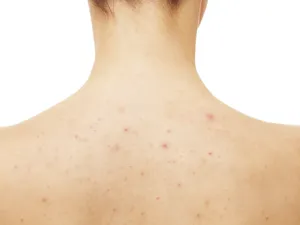 حبوب الظهر لا تظهر للعيان إلا أنها تؤرق صاحبها ناهيك عن أوجاعها

