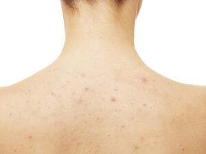 حبوب الظهر لا تظهر للعيان إلا أنها تؤرق صاحبها ناهيك عن أوجاعها

