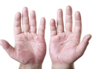 Psoriasis is a chronic, genetic autoimmune disease that causes red, scaly patches on the skin. 