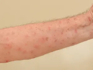 الجرب هو أحد الأمراض الجلديّة، ويسببه كائن طفيلي صغير جداً

