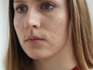 ظهور حب الشباب قبل الدورة بسبب إنخفاض مستوى الهرمونات
