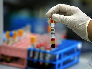 Learning the results of this medical blood test may impose an expiry date on your life.