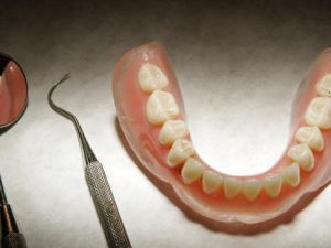 التهاب اللثة، فيمثل المرحلة الأولى لمرض ما حول الأسنان الذي يحصل نتيجة لظهور plaques أو قشور التي ليست سوى رواسب لزجة من البكتيريا والمخاط وفضلات الطعام التي تلتصق بالأسنان، فتتراكم وتسبّب التهابات