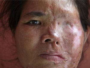 Acid violence is quite a common practice in many Far Eastern countries such as Cambodia, Sri Lanka, Indonesia