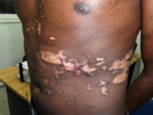 This Eritrean man was badly abused while being held in Sinai.