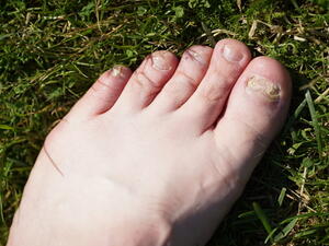 الصدمة – قد ينتج انغراز الظفر في اللحم 