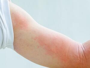 Symptoms of an Allergic Reaction to Insect Bites Can Include Rash