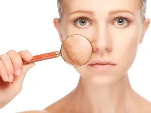 من مميزات علاج الكلف بالليزر بأنها طريقة حديثة وتمتاز بسرعة نتائجها