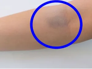 من أسباب ظهور بقع زرقاء في الجسم تناول بعض أنواع الأدوية، مثل الأسبرين