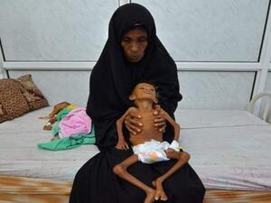  قرابة 358 ألف طفل يمني يعانون من سوء التغذية الحاد الشديد