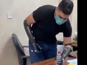 "فتى الزرقاء" يحصل على يدين اصطناعيتين ويبدأ العودة للحياة الطبيعية (فيديو)
