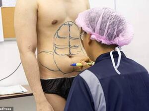 A photo ahead of the operation a photo shows the surgeon marking out individual abdomen muscles on his flat stomach. (Daily Mail)