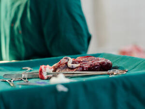 Freshly removed placenta after C-section in Indian hospital. (Shutterstock/ File Photo)