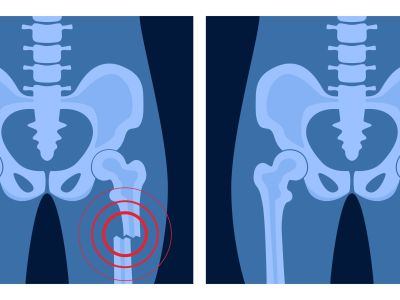 bone glue