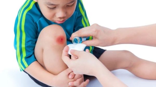 كيفية علاج الكدمات في المنزل؟