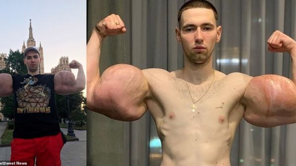 The disastrous implants were causing Mr Tereshin 'high fever, strong pain, and weakness'. (Alana Mamaeva)