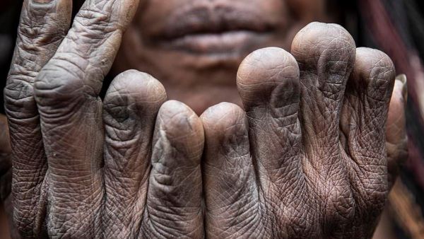 An older woman shows six fingers amputated to represent the loss of six loved ones. The tradition has not taken place since the 1990s  (DAILYMAIL)