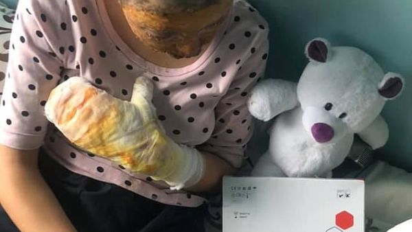 Anna Krytska, 16, recovering in hospital after she was doused in petrol and set alight by her father when she tried to stop him beating up her mother. Daily Mail