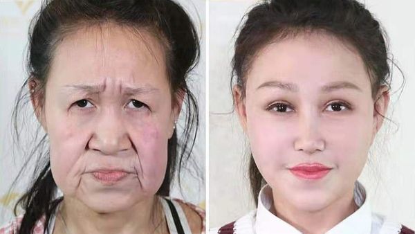 A handout picture released by China's Shenyang Sunline Plastic Surgery Hospital shows Xiao Feng's face before and after the surgery. The teenager met the public with her new looks today.(Shenyang Sunline Plastic Surgery Hospital)