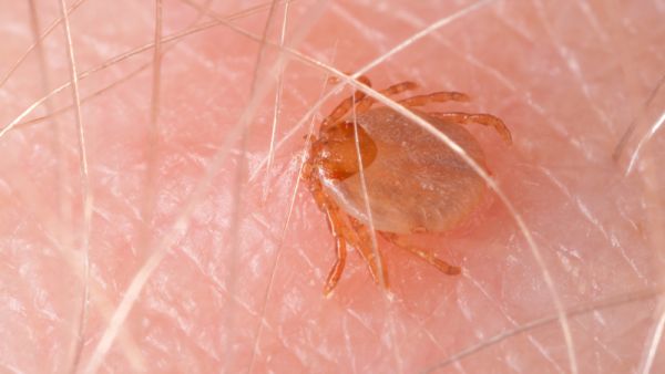 Maculosa fever tick drinking blood biting human skin - Typhoid typhus  (Shutterstock)	