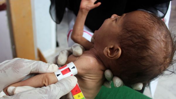 A Yemeni child suffering from malnutrition is measured at a treatment centre in Yemen's northern Hajjah province on July, 5, 2020. The war in Yemen, the Arabian peninsula's poorest country, has mutated into what the United Nations calls the world's worst humanitarian crisis. (AFP)
