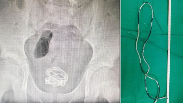 سلك كهربائي بطول 60 سم يستقر في مثانة طفل صيني