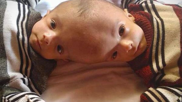 Yemeni conjoined twins Yousef and Yassin