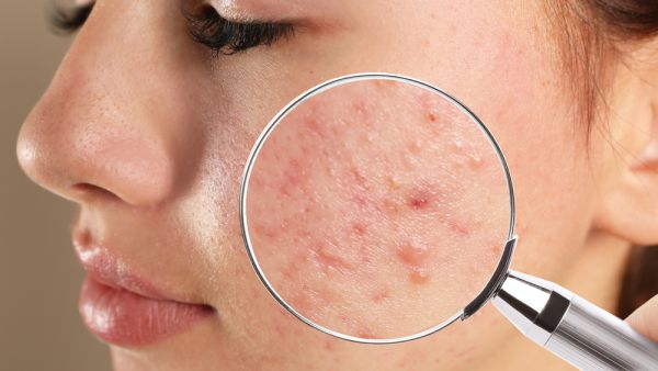 A teen with acne problems