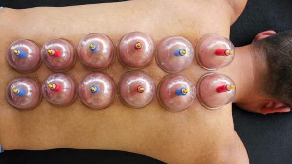 Multiple vacuum cup of medical cupping therapy on human body