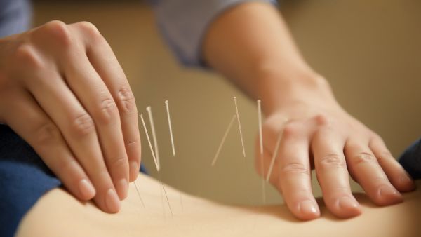 علاج الوخز بالإبر للحامل