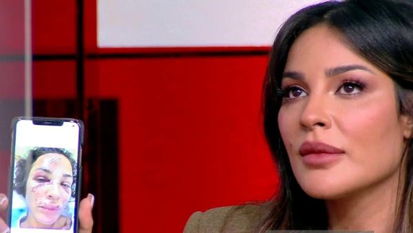 Nadine Njeim smashed face bruised Beirut Blast
