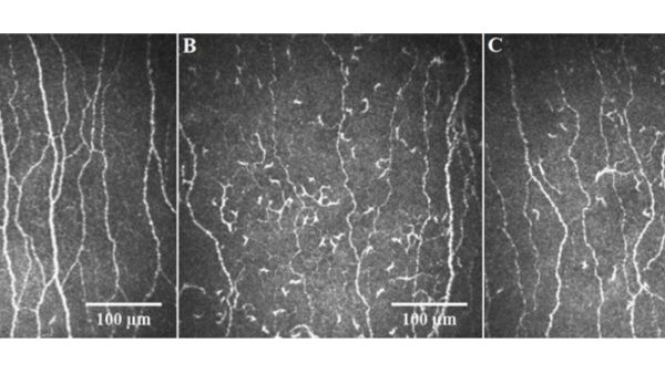 The nerve damage caused by COVID-19 and long COVID can be seen in these corneal images. Image (A) shows a healthy patient, (B) shows a patient with long COVID and (C) shows a patient with COVID-19. WCM-Q Researchers Use Pioneering Eye Exam To Identify Nerve Damage In Long Covid Patients