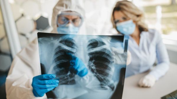 7 علاجات منزلية لأعراض الالتهاب الرئوي