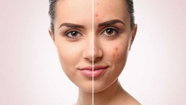 8 طرق للتخلص من ندوب حب الشباب