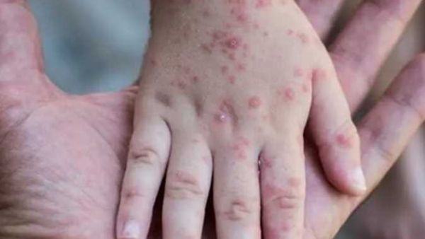 تتوقع منظمة الصحة العالمية ارتفاع حالات الإصابة بجدري القرود