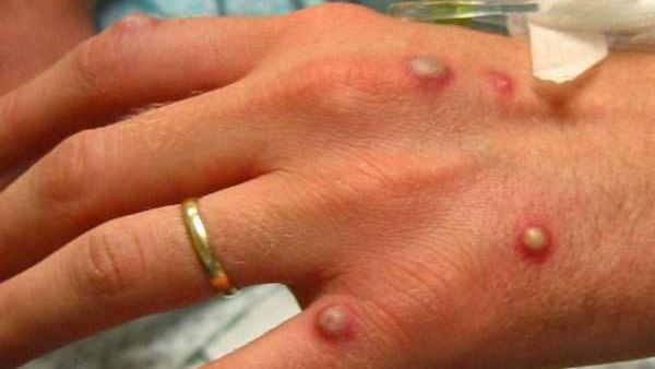 جدرى القرود