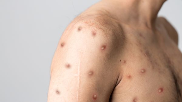 Monkeypox cases