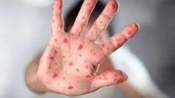 جدري القرود