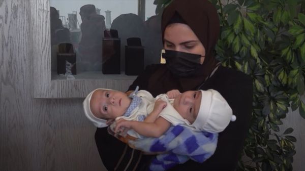 يشارك في عملية فصل التوامين وهما أبناء المواطن العراقي محمد عبدالله جاسم، 27 من الاستشاريين 