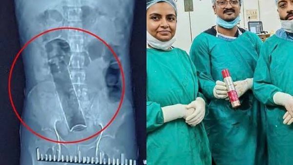 مزيل عرق في أمعاء مريض في الهند