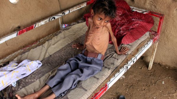 طفل يبلغ من العمر 10 سنوات يعاني من سوء التغذية الحاد بمحافظة حجة اليمنية