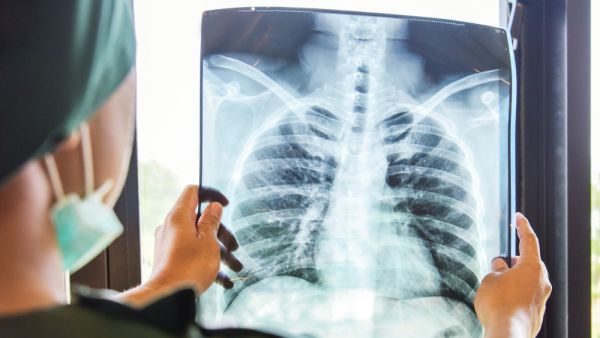 Tuberculosis deaths rising again in Europe