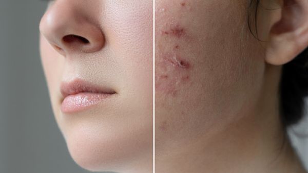  2 من أفضل سيرومات البشرة الحساسة في صيف 2023 لبشرة أنقى، أجمل وقوية أكثر 