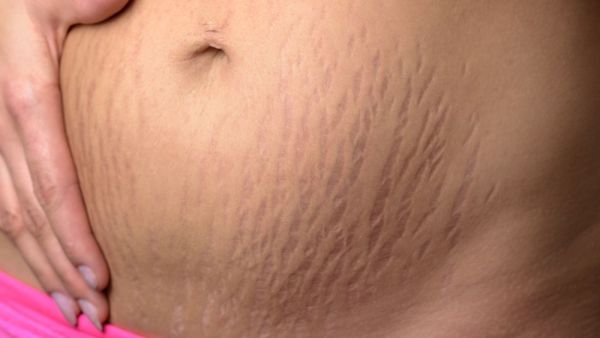3 كريمات مختبرة لإزالة علامات التمدد المزعجة ونصائح حول كيفية تطبيقها