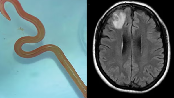 Brain 